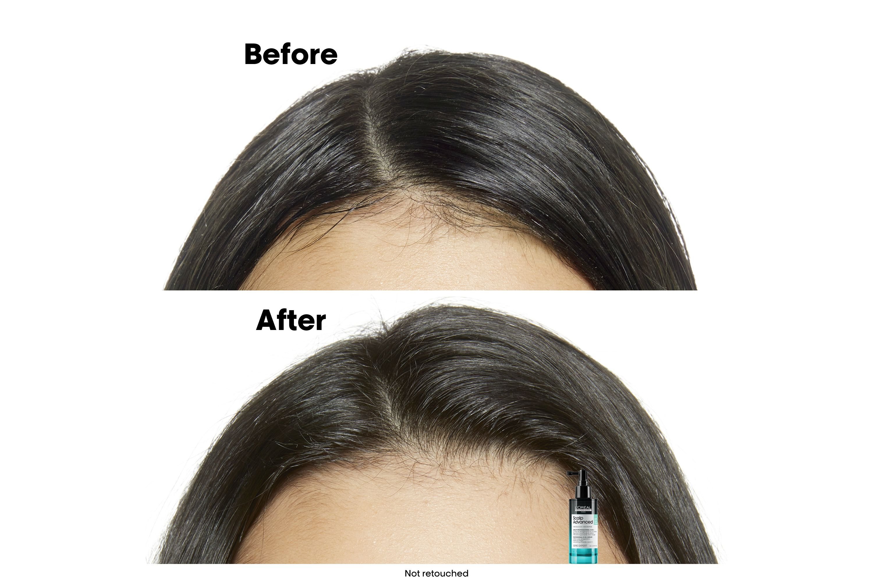 سيروم L’Oréal Professionnel Scalp Advanced لمكافحة الدهون - 90 مل thumbnail 4