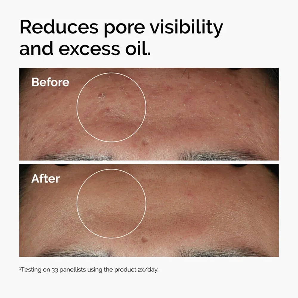 The Ordinary Niacinamide 10% + Zinc 1% Serum - 120 ml thumbnail 5